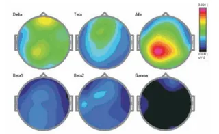 Research on HDH EEG Brainstate Patterns-Baseline Eyes Open Condition