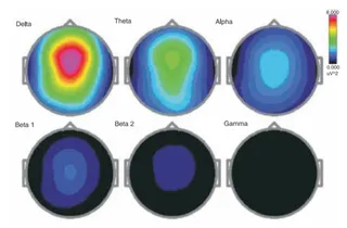 Research on HDH EEG Baseline Meditation Condition