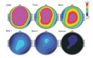 Research on HDH EEG Baseline Eyes Closed Condition