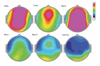 Research on HDH EEG Brainstate Patterns-Baseline Eyes Open Condition