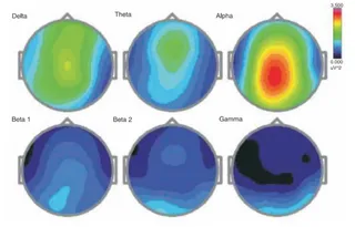 Research on HDH EEG Brainstate Patterns-Baseline Eyes Open Condition